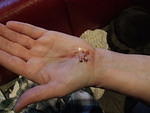 Jane Sutures from surgery to releave her carpal tunnel syndrome.